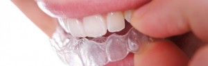 teeth-whitening-630x200