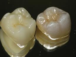 Coroane din ceramica pe suport din oxid de zirconiu